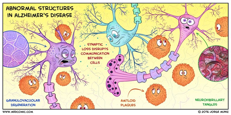 Abnormal-Structures-in-Alzheimer-Disease.jpg