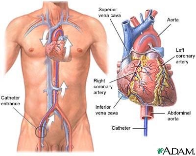 cardiaccatheterization.jpg