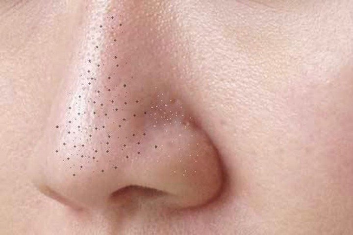 blackheads removal.jpg