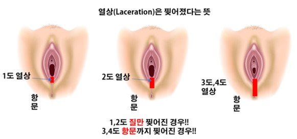 회음부절개-회음부열상.jpg