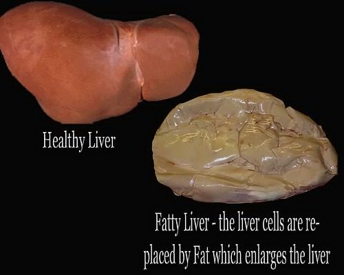 Fatty-Liver-Disease.jpg