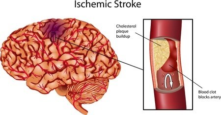 ischemic-stroke.jpg