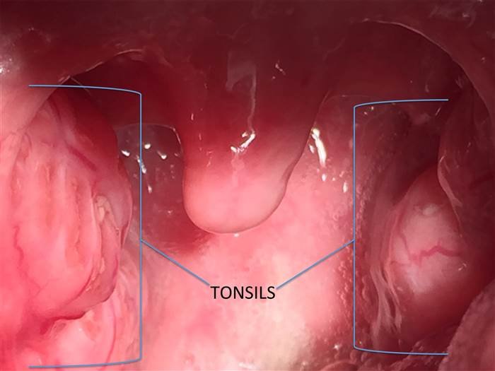 tonsil-graphics-today-170116-inline_9a059ed429438893c5349ea0159ab573.today-inline-large.jpg