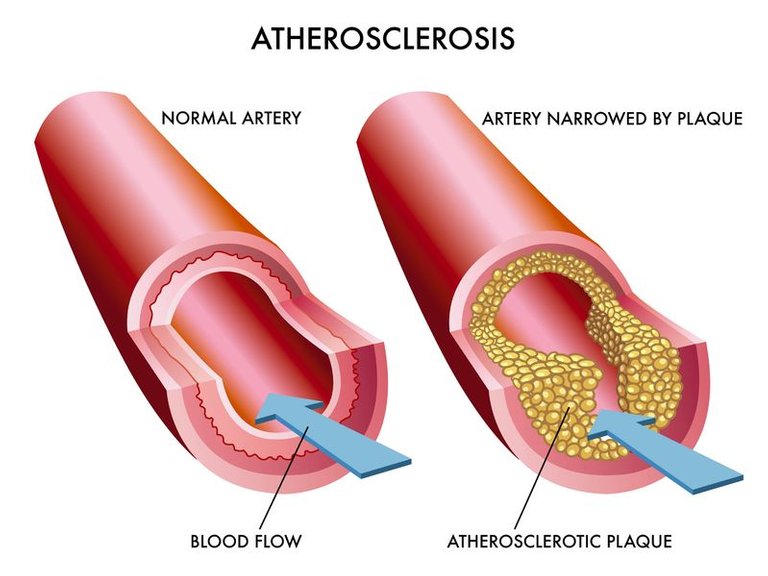 atherosclerosis.jpg