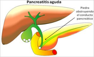 pancreatitis lito.jpg