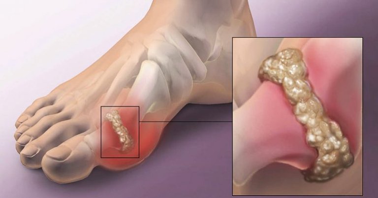 THS_Dec04_Part04_03_How-To-Remove-Gout-and-Joint-Pain-Uric-Acid-and-Crystals-798x418.jpg