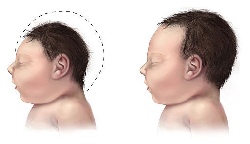 Microcephaly-comparison-500px.jpg