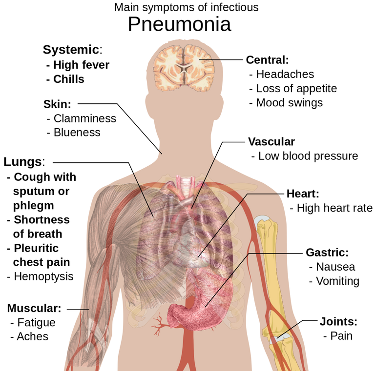 Symptoms_of_pneumonia.svg.png