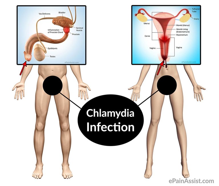 chlamydia-infection-popup.jpg