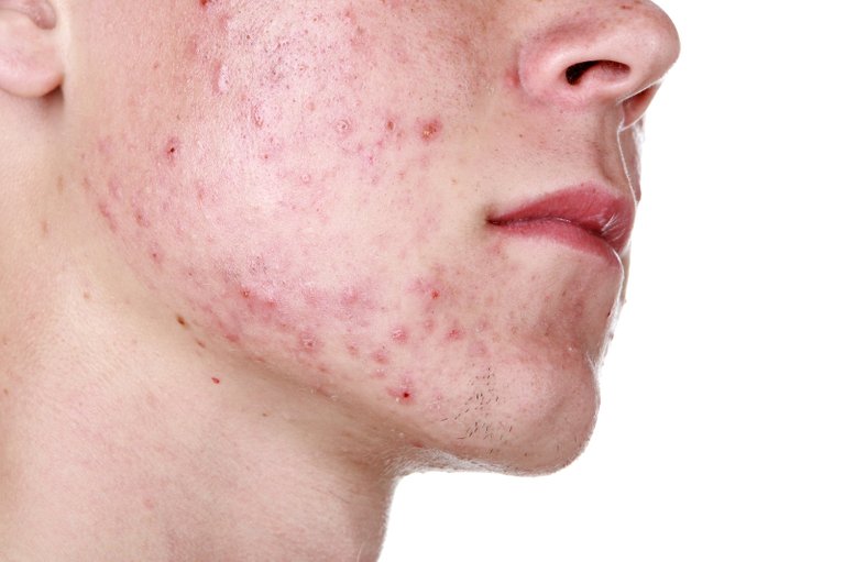 bigstock-Severe-Acne-24802256.jpg