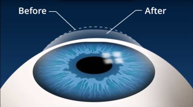 window_and_how_lasik_works_-_youtube.png