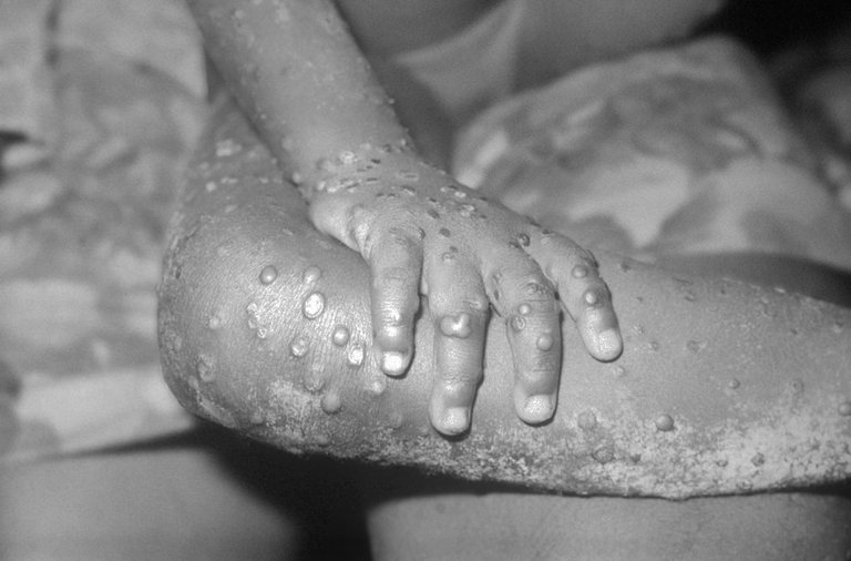 1200px-Monkeypox.jpg