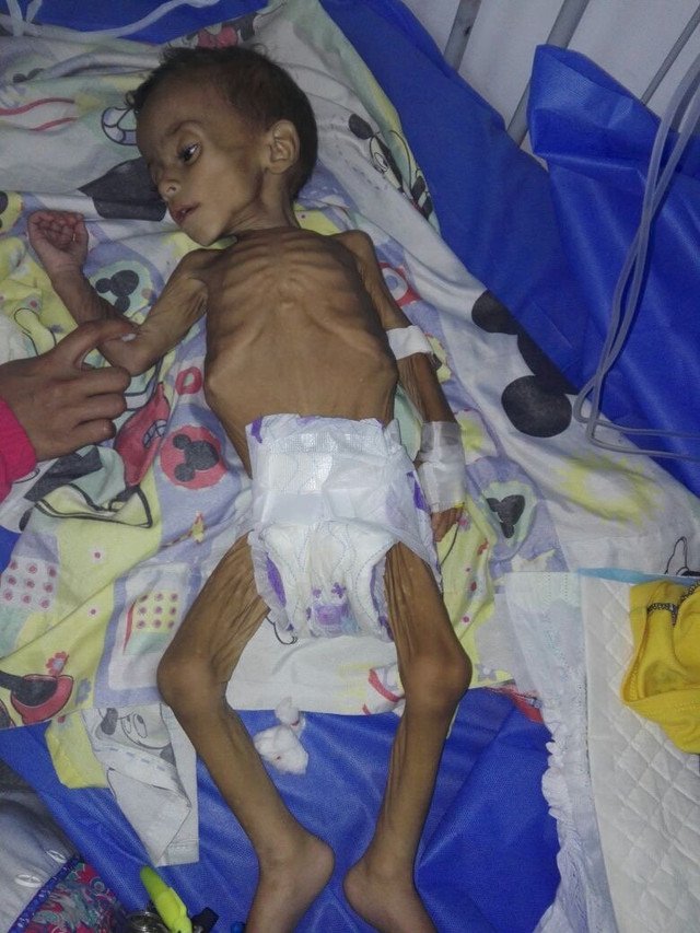 Photo of starving baby by DR. LIVIA MACHADO