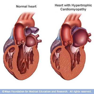 Hypertrophic+Cardiomyopathy.jpg