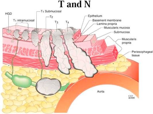 esophageal-cancerfig2_large.jpg