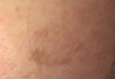 melasma_article_after2.jpg