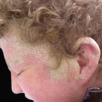 scabies-norwegian-or-crusted-s14.jpg