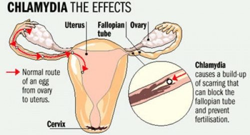 Natural-Remedies-to-Get-Rid-of-Chlamydia.jpg