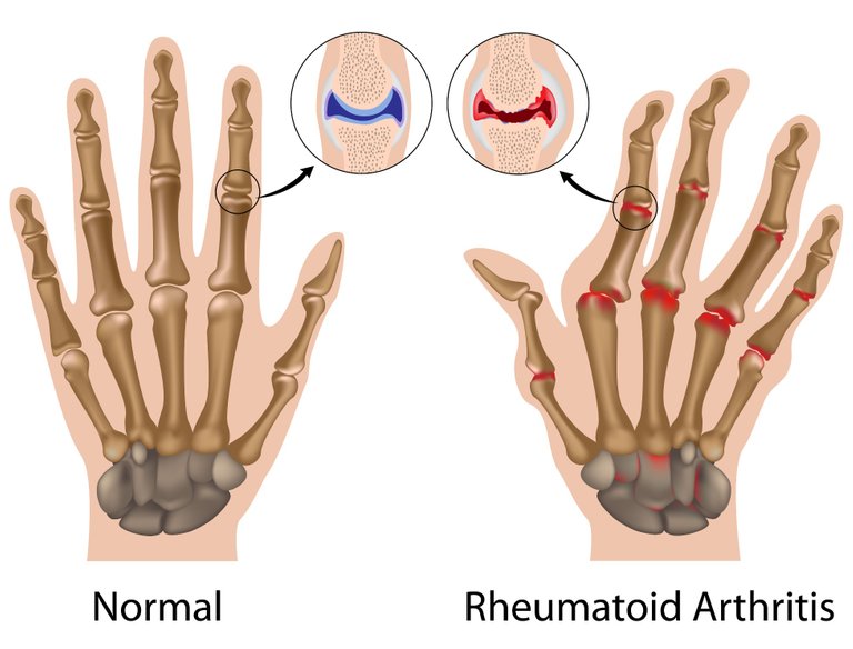 2-Qué-es-la-artritis-a-quién-afecta-y-cómo-prevenirla-2.jpg