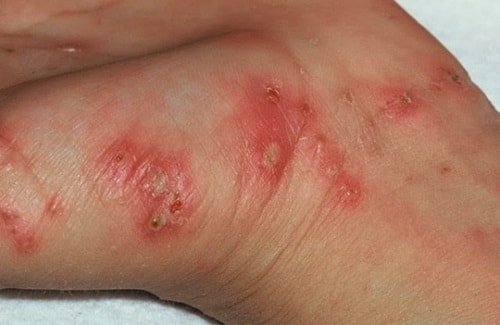 scabies1.jpg