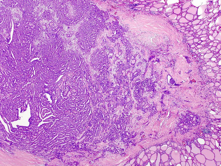 Thyroid_papillary_carcinoma_histopatholgy_(1).jpg