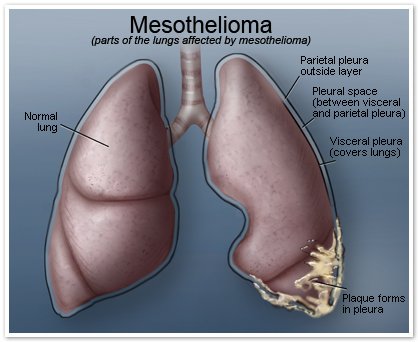 mesothelioma.jpg