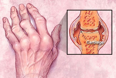 photolibrary_rf_illustration_of_joint_with_rheumatoid_arthritis..jpg