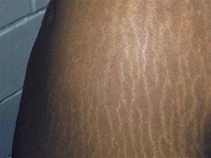 Lightening_Stretch_Marks-300x225.jpg