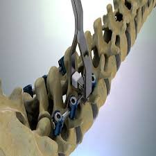 global vascular graft market.jpg