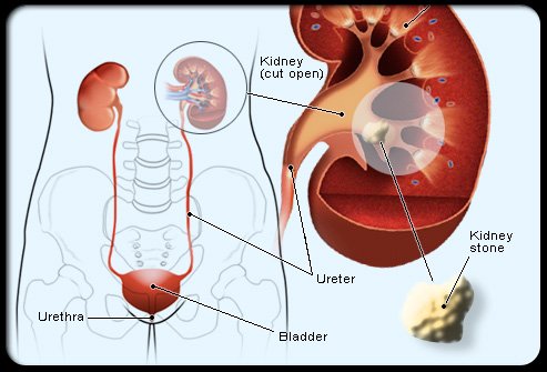 kidney_stone_s2_common_cause-1.jpg