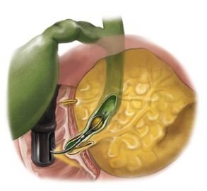 Endoscopic Baskets.jpg