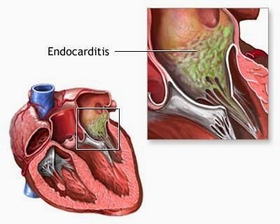 Infective Endocarditis.jpg