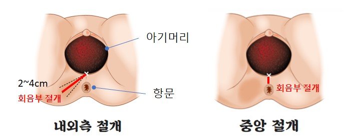 내외측절개 중앙절개.jpg