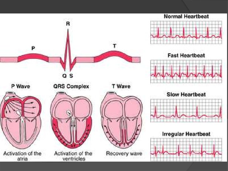 arritmias-cardiacas-3-728.jpg