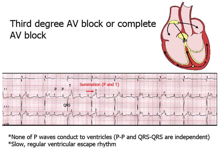 third degree block.png