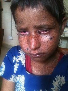 220px-Child_suffering_from_Xeroderma_Pigmentosum_in_Rukum,Nepal.jpg