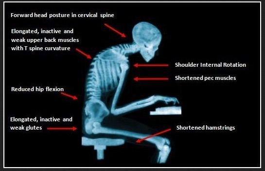 bad posture xray.jpg