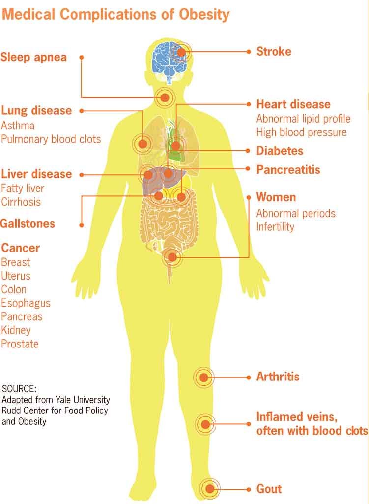 751px-Medical_complications_of_obesity.jpg