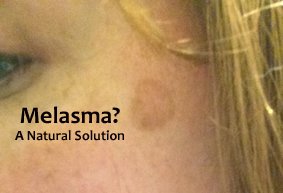 melasma-header2.jpg