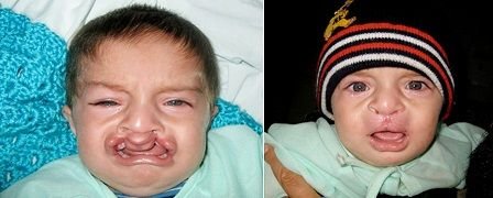 cleft lip repair.JPG