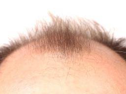 top-of-head-with-receding-hairline.jpg