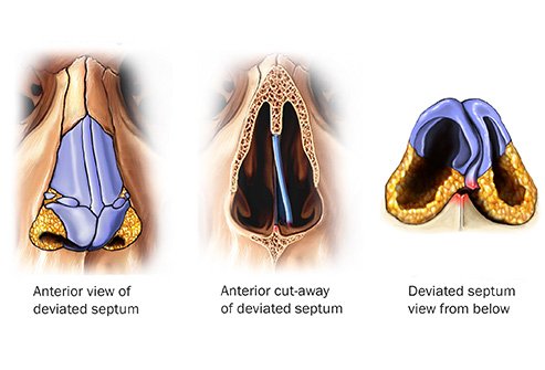 nucleus_medical_rf_deviated_septum_illustration.jpg