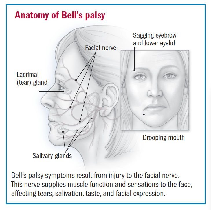Bells-palsy.jpg