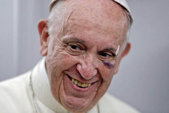 POPE-FRANCIS-BLACK-EYE-1061705.jpg