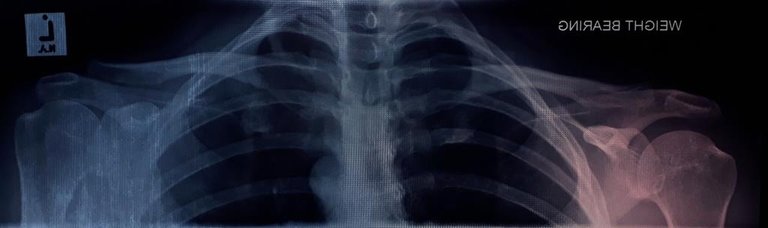 shoulder  Xray.jpg