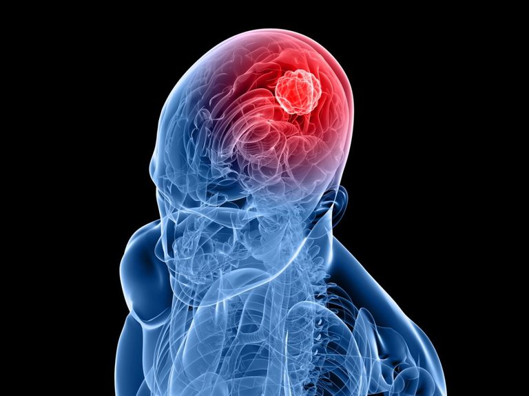 human-brain-with-tumor.jpg