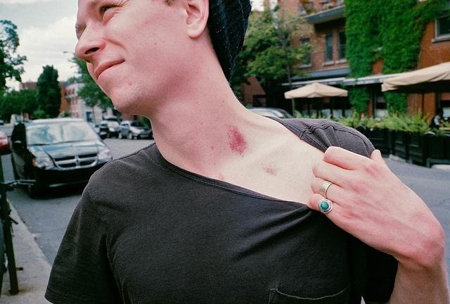 is-the-deadly-hickey-an-urban-legend-or-a-terrifying-reality-body-image-1473033175.jpg