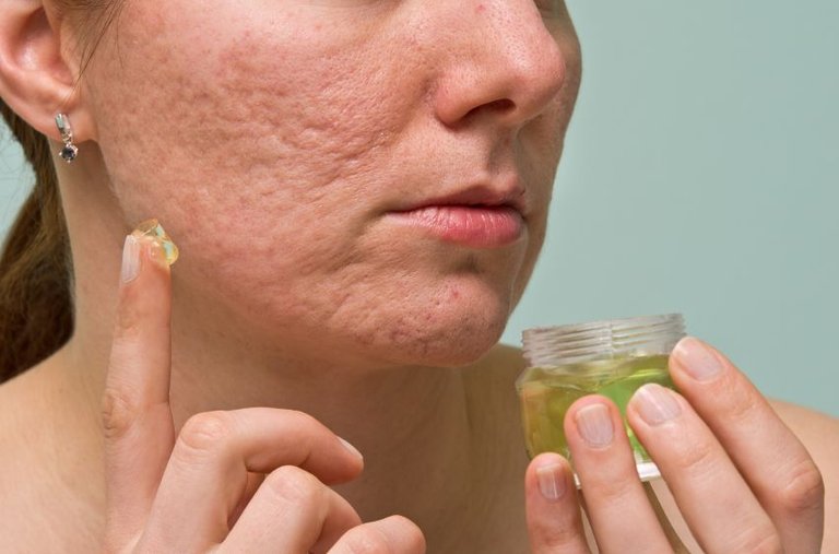 acne-scars-aloe-vera.jpg