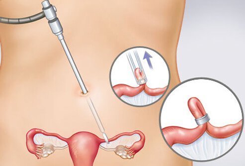 birth-control-s15-illustration-of-tubal-ligation-surgery.jpg