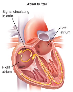 Cross-section-of-heart-showing-atrial-flutter-_12519.jpg